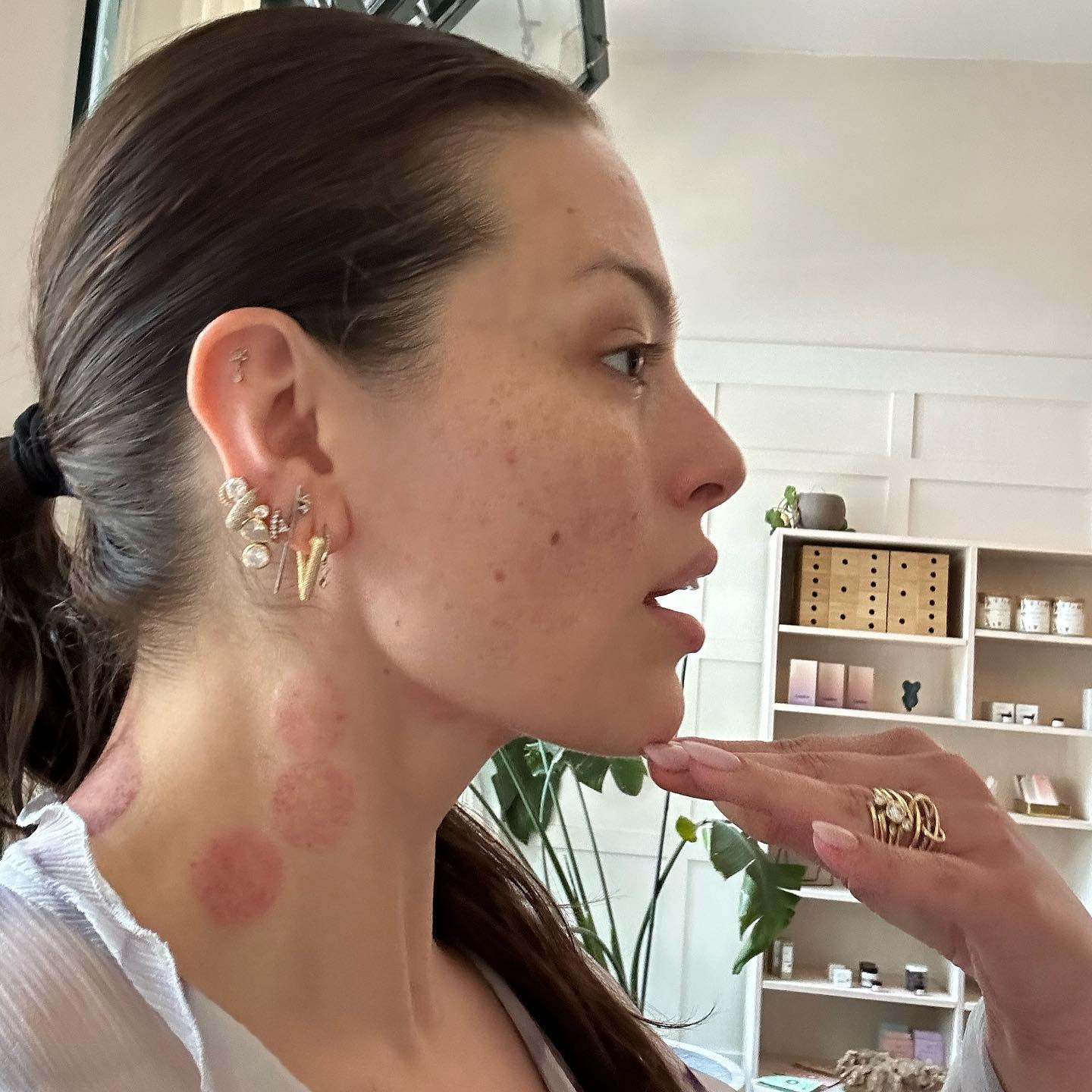 ashley-jpeg-2166-1686029254 Ashley Graham khoe gương mặt sau khi cạo gió và giác hơi. Ảnh: Instagram Ashley Graham