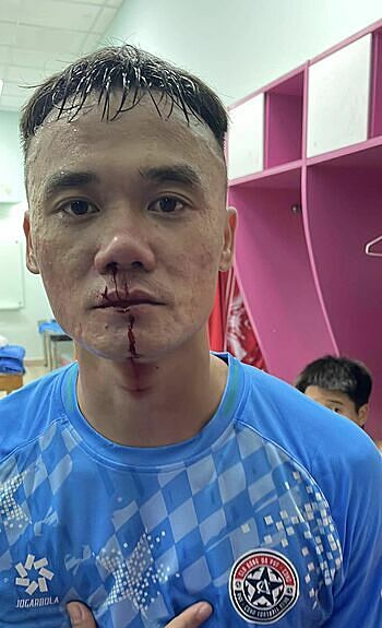 nguyen-xuan-nam-pvf-cand-tre-t-1445-7353-1731600721 CLB PVF-CAND đăng ảnh tiền đạo Nguyễn Xuân Nam chảy máu mũi sau vụ đánh nhau với cầu thủ Trẻ TP HCM. Ảnh: Facebook/CLB Bóng đá PVF-CAND