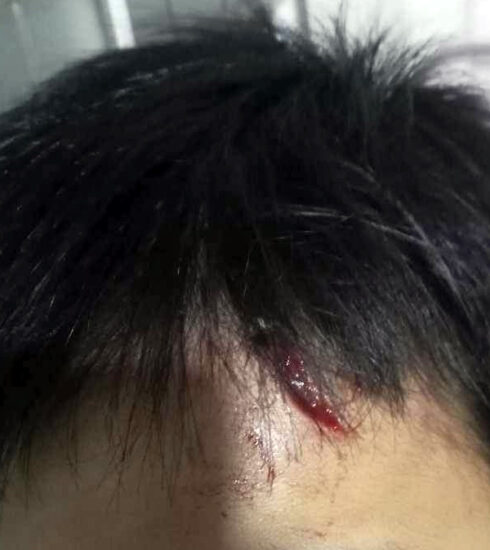 Vết thương trên trán của bé trai 10 tuổi. Ảnh: Gia đình cung cấp