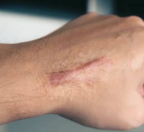 Vùng da bị sẹo có nhiều khác biệt với da xung quanh. Ảnh: Ạthletico